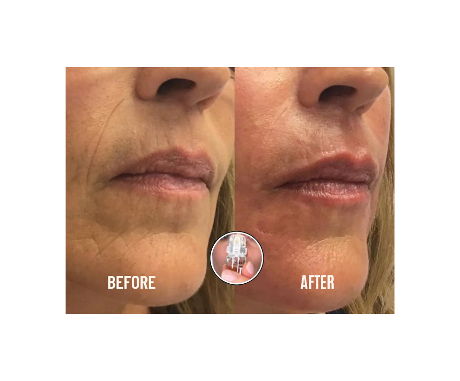 Firming Micro Needle Facial Serum