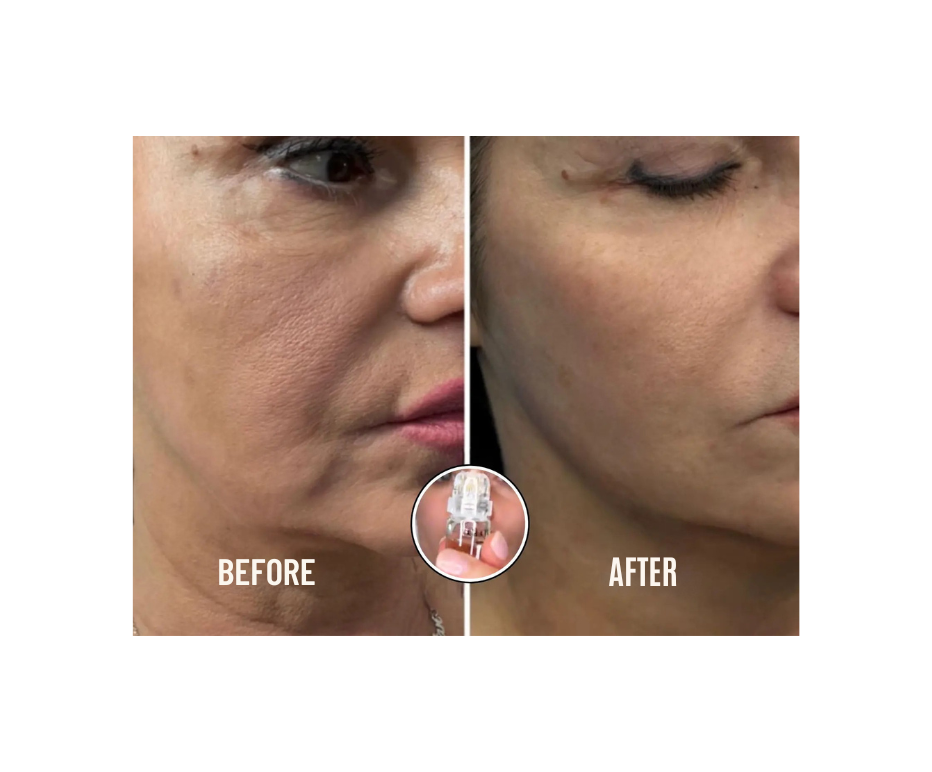 Firming Micro Needle Facial Serum