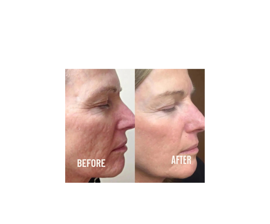Firming Micro Needle Facial Serum