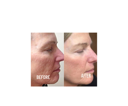 Firming Micro Needle Facial Serum